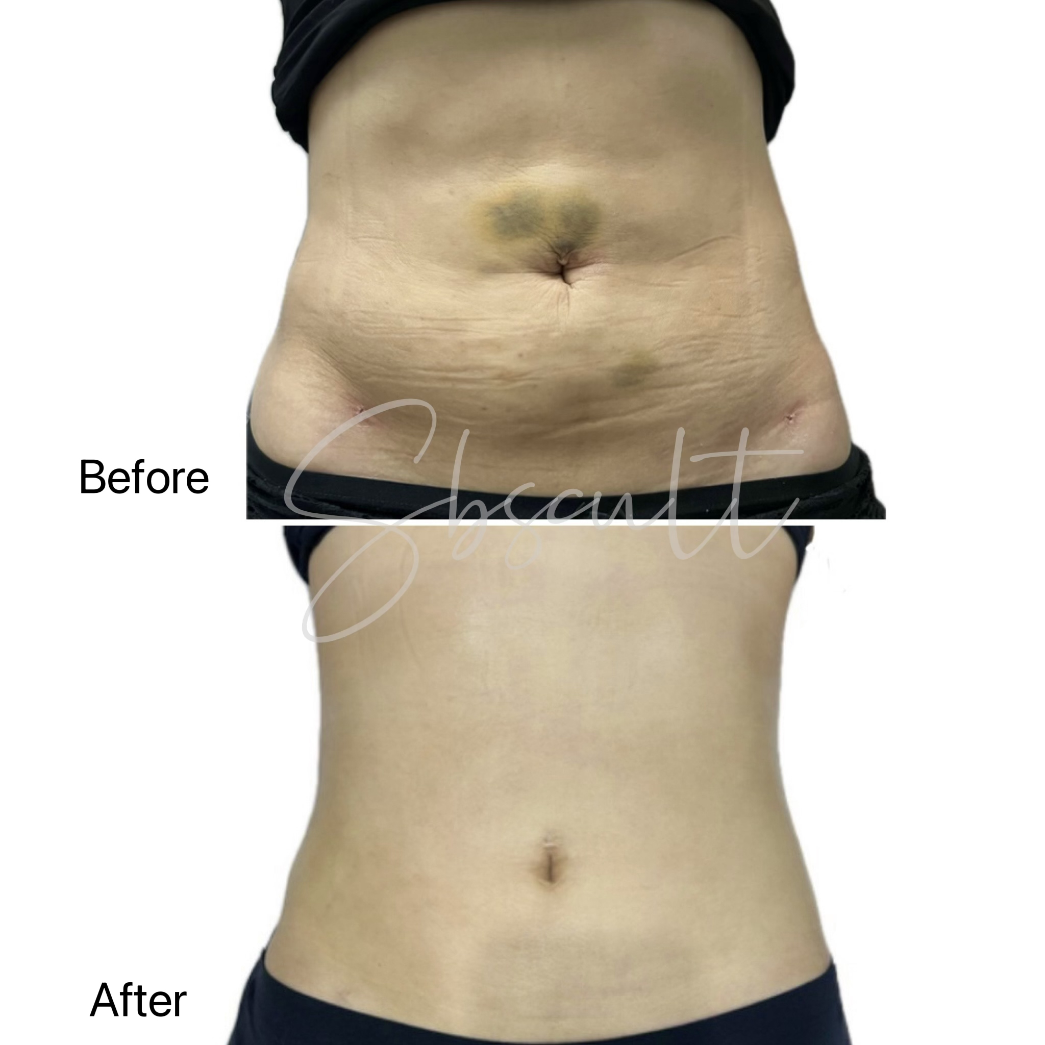 Before-and-after composite showing an abdomen in two panels, with Before above After and an SBS Cult watermark across the center.