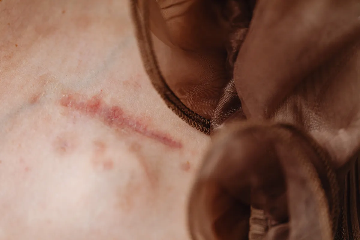 Close-up of a healed surgical scar